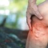 Man gripping leg with untreated varicose veins showing visible bulging veins and inflammation
