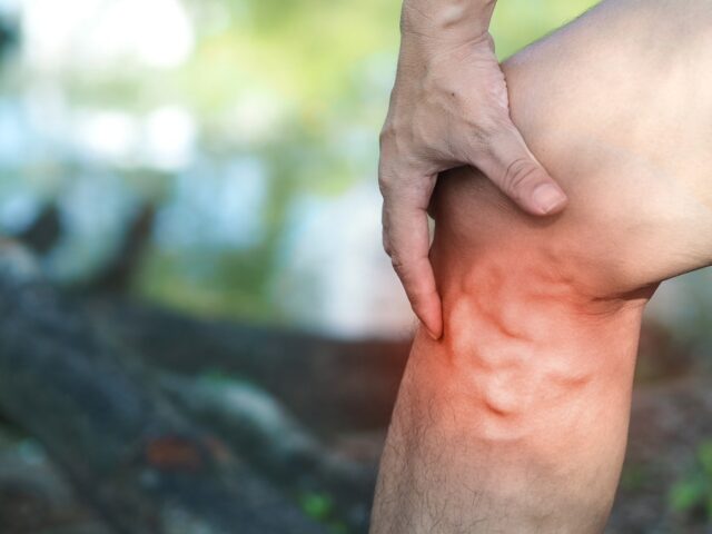 What Happens If You Leave Varicose Veins Untreated?