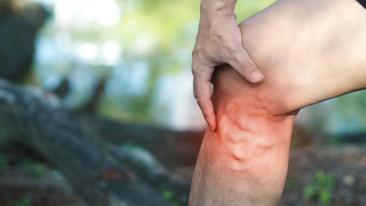 Man gripping leg with untreated varicose veins showing visible bulging veins and inflammation